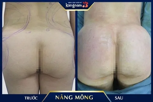 mông cong có tốt không 