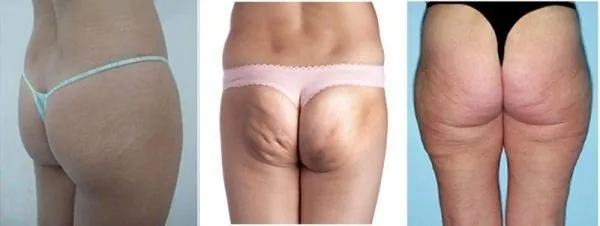 Tình trạng mông teo tóp không có mô tuyến mỡ thì phương pháp luyện tập không hiệu quả mông nhỏ mặc quần gì