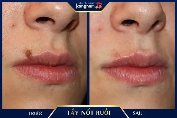 Kết quả khách hàng sau khi tẩy nốt ruồi tại Kangnam