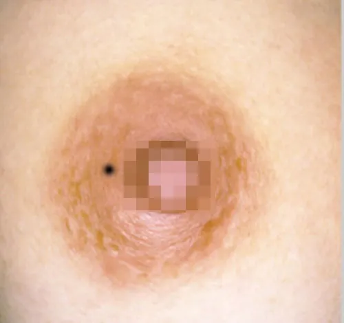 nốt ruồi ở gần nhũ hoa 