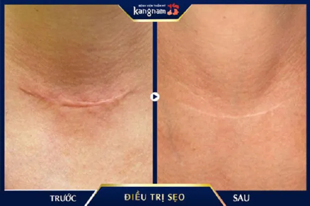 Vết sẹo lâu năm trên lưng mờ hoàn toàn sau 1 liệu trình điều trị bằng thuốc đặc trị