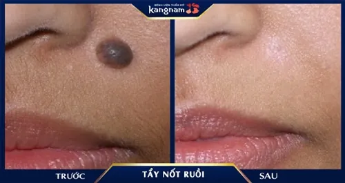 Hình ảnh khách hàng tẩy mụn ruồi thâm đen, lồi, kích thước lớn thành công đến 99% không để lại sẹo
