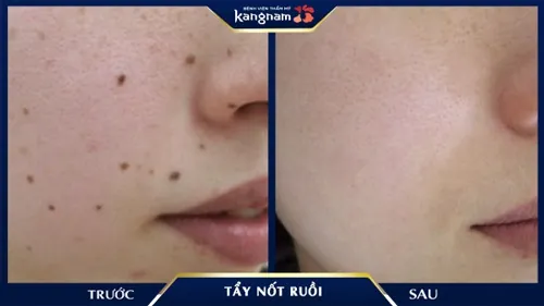 Các mảng nốt ruồi nhiều kích thước mọc chi chít quanh mặt đã biến mất hoàn toàn sau khi điều trị tại Kangnam