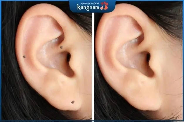 Tẩy nốt ruồi ở tai an toàn tại Kangnam