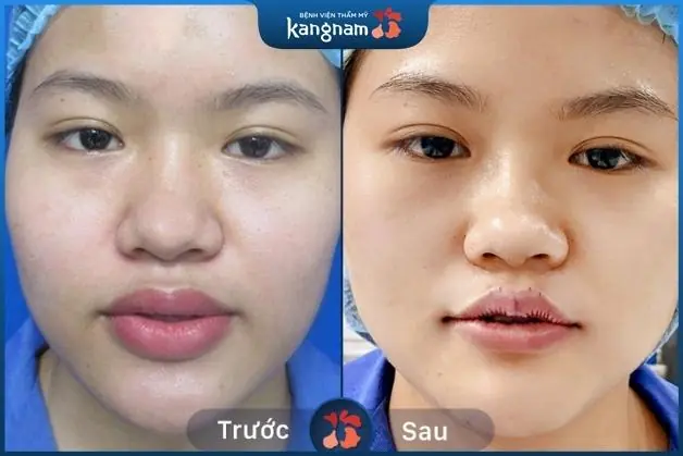 Tùy theo dáng mỗi của từng khách hàng mà bác sĩ sẽ tư vấn phương pháp chỉnh sửa phù hợp (*)