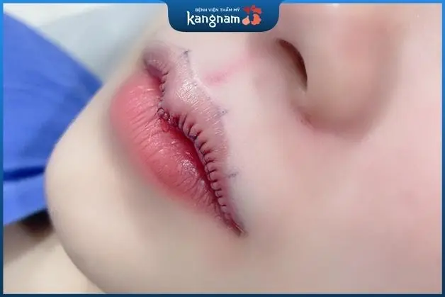 Vùng môi được đo vẽ cẩn thận đảm bảo sự cân xứng