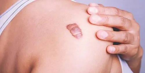 Tiêm trị sẹo lồi chỉ phù hợp với 1 số trường hợp sẹo nhỏ, đơn giản