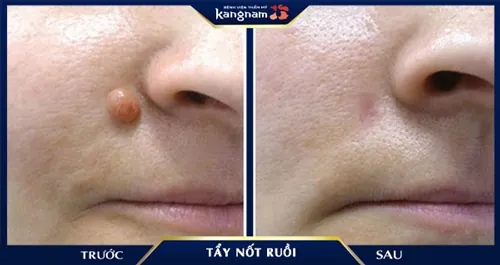 Mụn ruồi lớn, lồi nhiều trên bề mặt da đã được xử lý triệt để sau 1 liệu trình sử dụng Laser CO2 Fractional