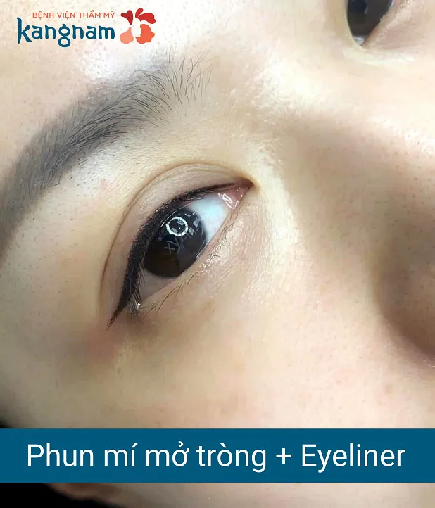 Đường viền mí sắc xảo tạo điểm nhất hút hồn cho đôi mắt sau khi phun xăm tại Kangnam