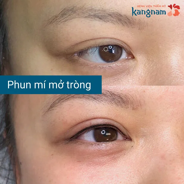 Đôi mắt to tròn long lanh và có hồn hơn sau phun xăm mí mắt