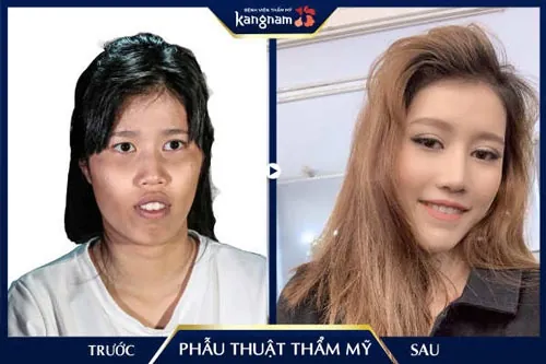 có nên phẫu thuật thẩm mỹ