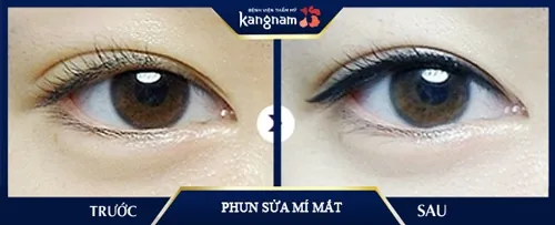 phun sửa mí mắt bị hỏng 
