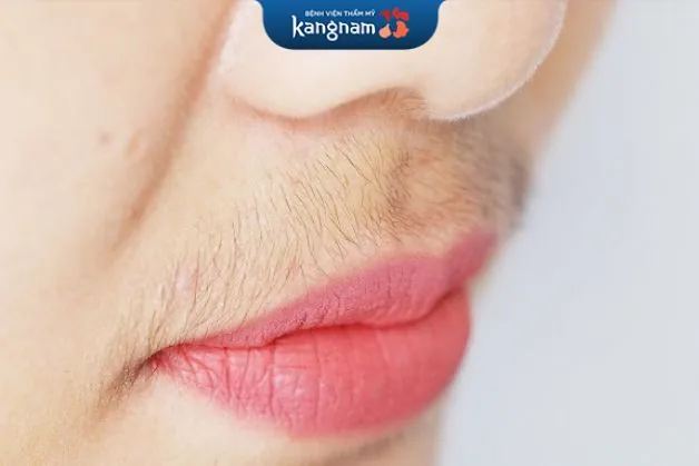 Ria mép nữ xuất hiện là do sự rối loạn hoocmon nội tiết trong cơ thể