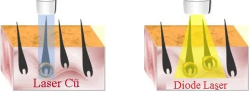 tẩy lông mép