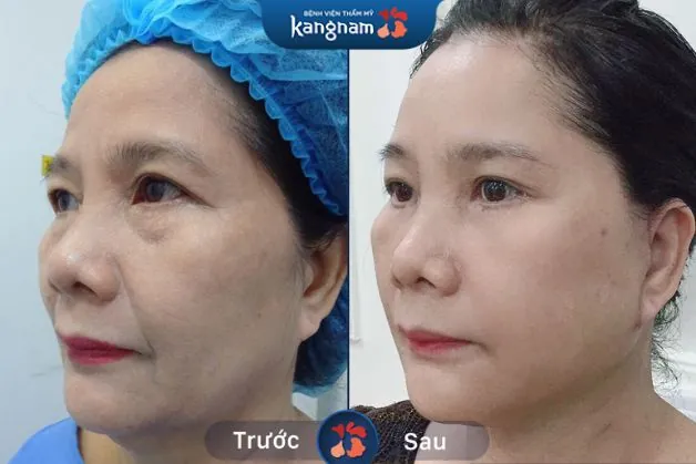 Trẻ hóa an toàn tại Kangnam