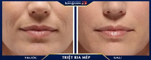 triệt lông mép