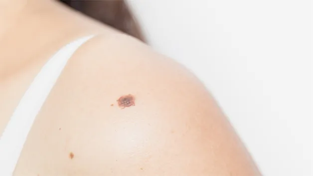 Nốt ruồi ở bắp tay trái là người tài năng