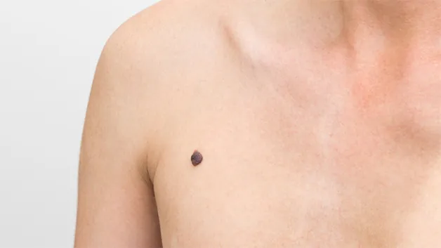 Ý nghĩa của nốt ruồi son trên cánh tay phải 