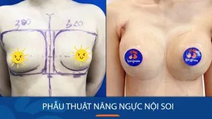 Phẫu thuật nâng ngực nội soi