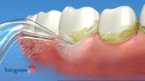 cạo vôi răng bị chảy máu