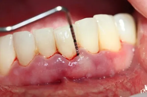 cạo vôi răng giá rẻ tphcm 