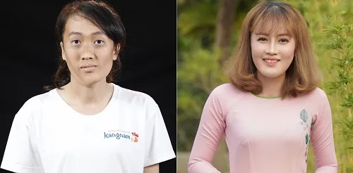 Nhìn trực diện: Hai hàm trên dưới cân đối, khuôn mặt hài hòa, chuẩn khớp cắn