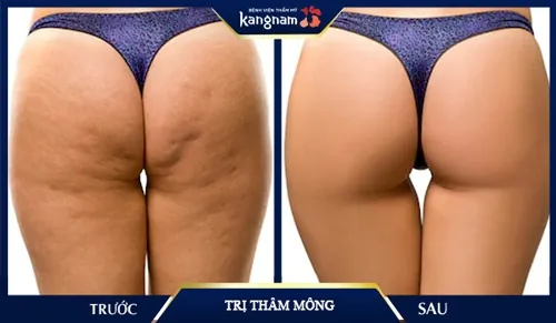 trị thâm mông bằng laser có hiệu quả không