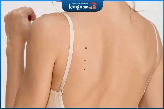 3 nốt ruồi thẳng hàng