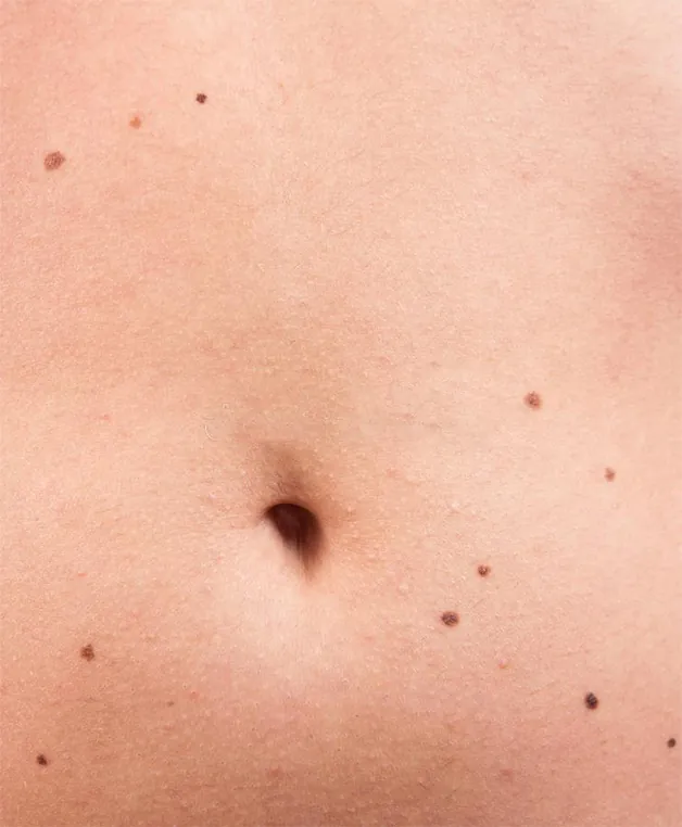 Nốt ruồi xuất hiện quá nhiều quanh vùng bụng có thể làm ảnh hưởng tới tính thẩm mỹ và cần phải xóa bỏ