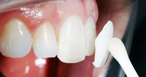 răng thỏ tướng số 