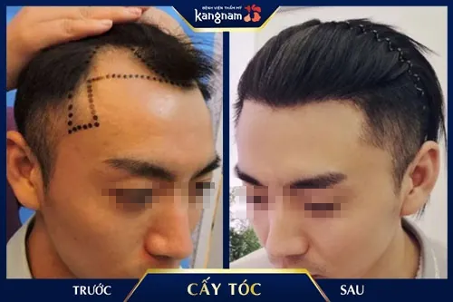 hói trán chữ m