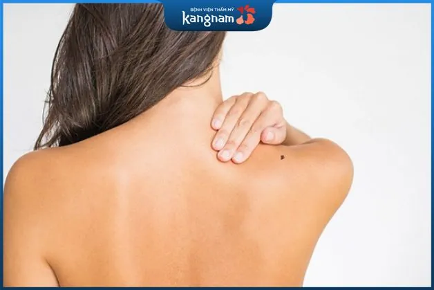 Nốt ruồi vai sau lưng là điềm may mắn cho người phụ nữ