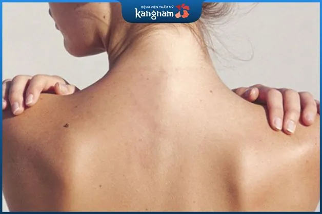 Mụn ruồi sau lưng bên trái