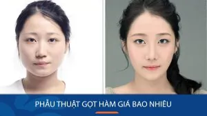 Phẫu thuật gọt hàm giá bao nhiêu