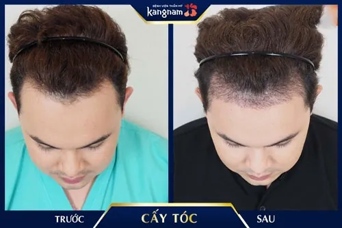 tóc hói ở trán