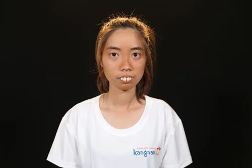 ảnh trước phẫu thuật nguyễn thị huê