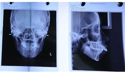 chụp xương nguyễn thị huê