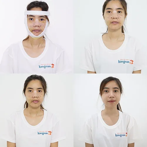 quá trình hồi phục nguyễn thị huê tại kangnam