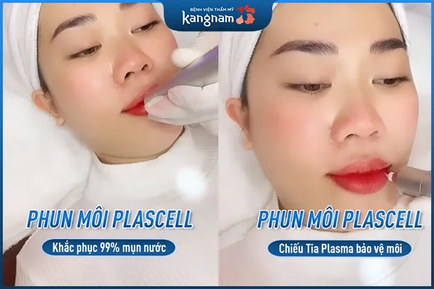 Yên tâm phun môi với công nghệ Plascell