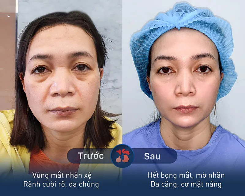 nâng cơ mặt có đau không