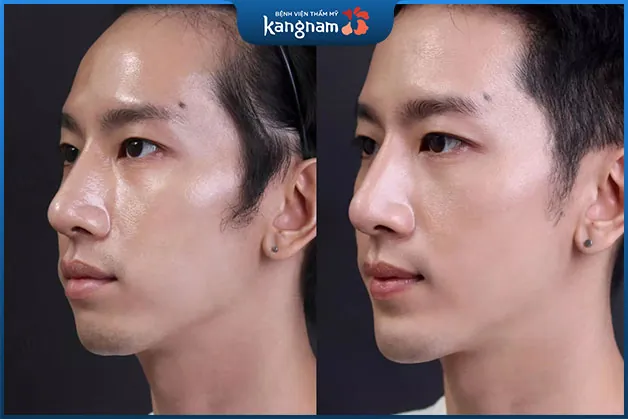 Độn cằm có hết hô không?