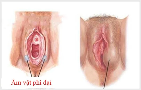 môi bé phì đại