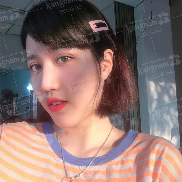 Mũi L Line phù hợp với những ai