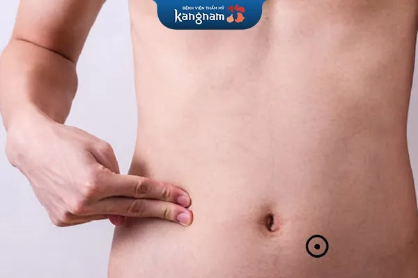 mụn ruồi bên phải rốn