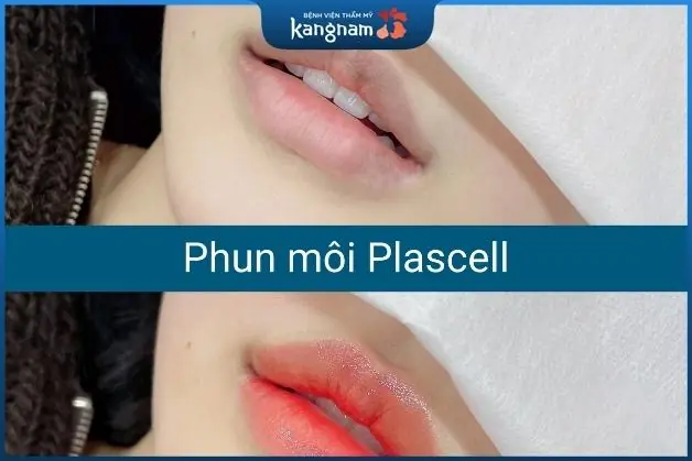 Phun xăm Plascell tại BV Kangnam
