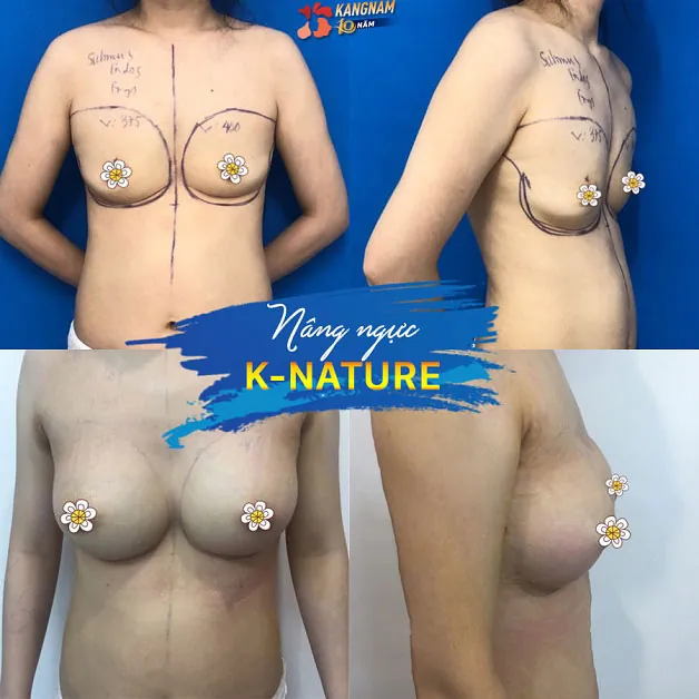 Hình ảnh khách hàng sau khi nâng ngực K-Nature