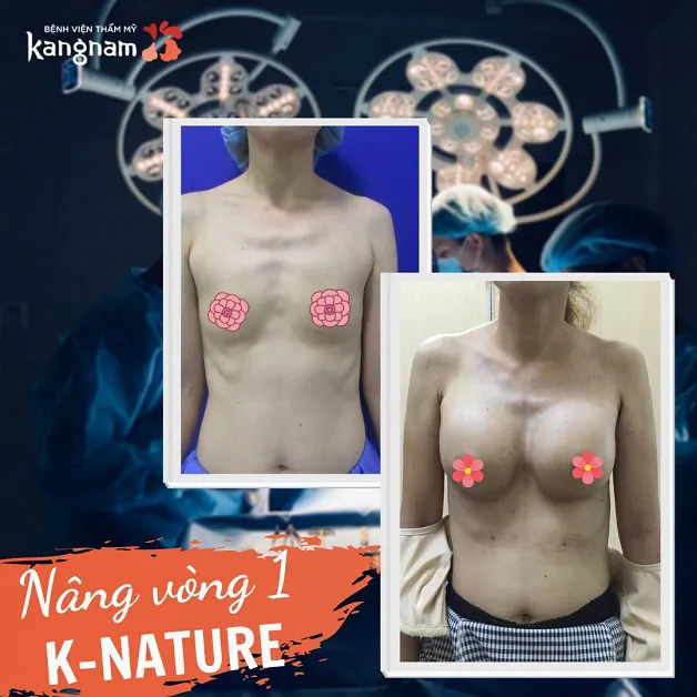 Nâng vòng 1 K-Nature