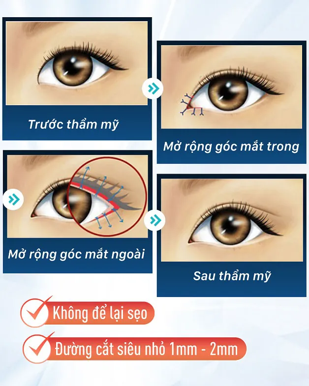 Cắt mí 6D - Công nghệ Cắt mí vi phẫu độc quyền tại Kangnam