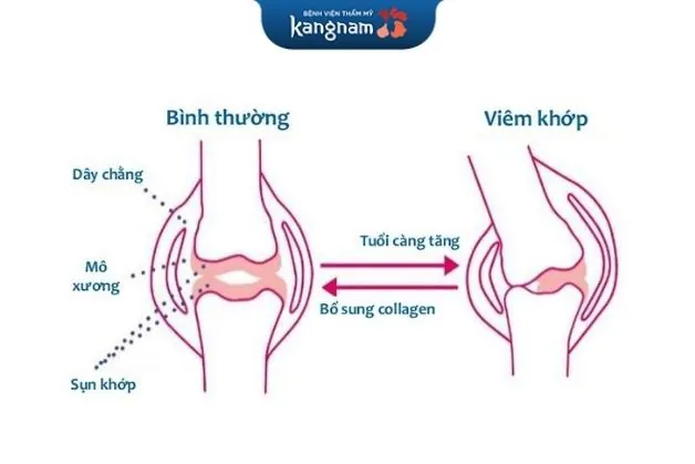 Collagen giảm thoái hóa khớp