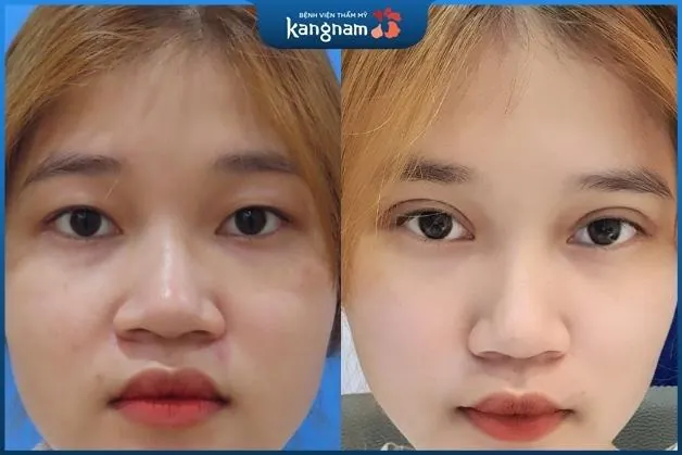 Nếp mí nhìn rất tự nhiên và không để lại sẹo